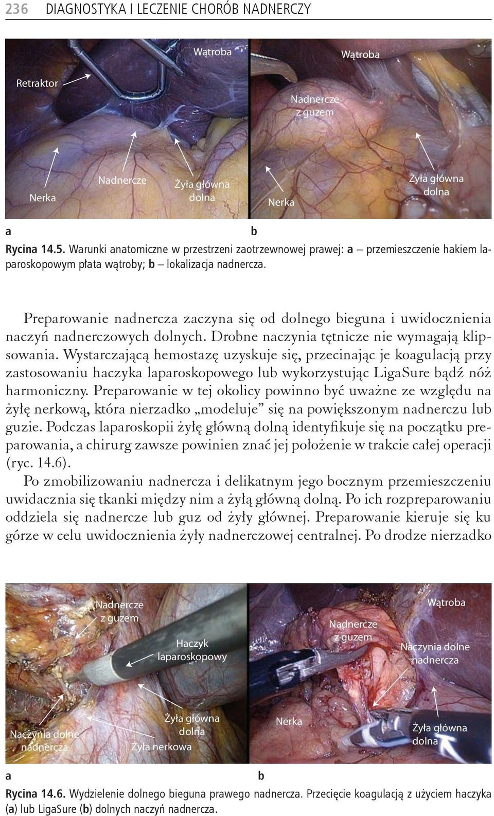 Preparowanie nadnercza zaczyna się od dolnego bieguna i uwidocznienia naczyń nadnerczowych dolnych. Drobne naczynia tętnicze nie wymagają klipsowania.