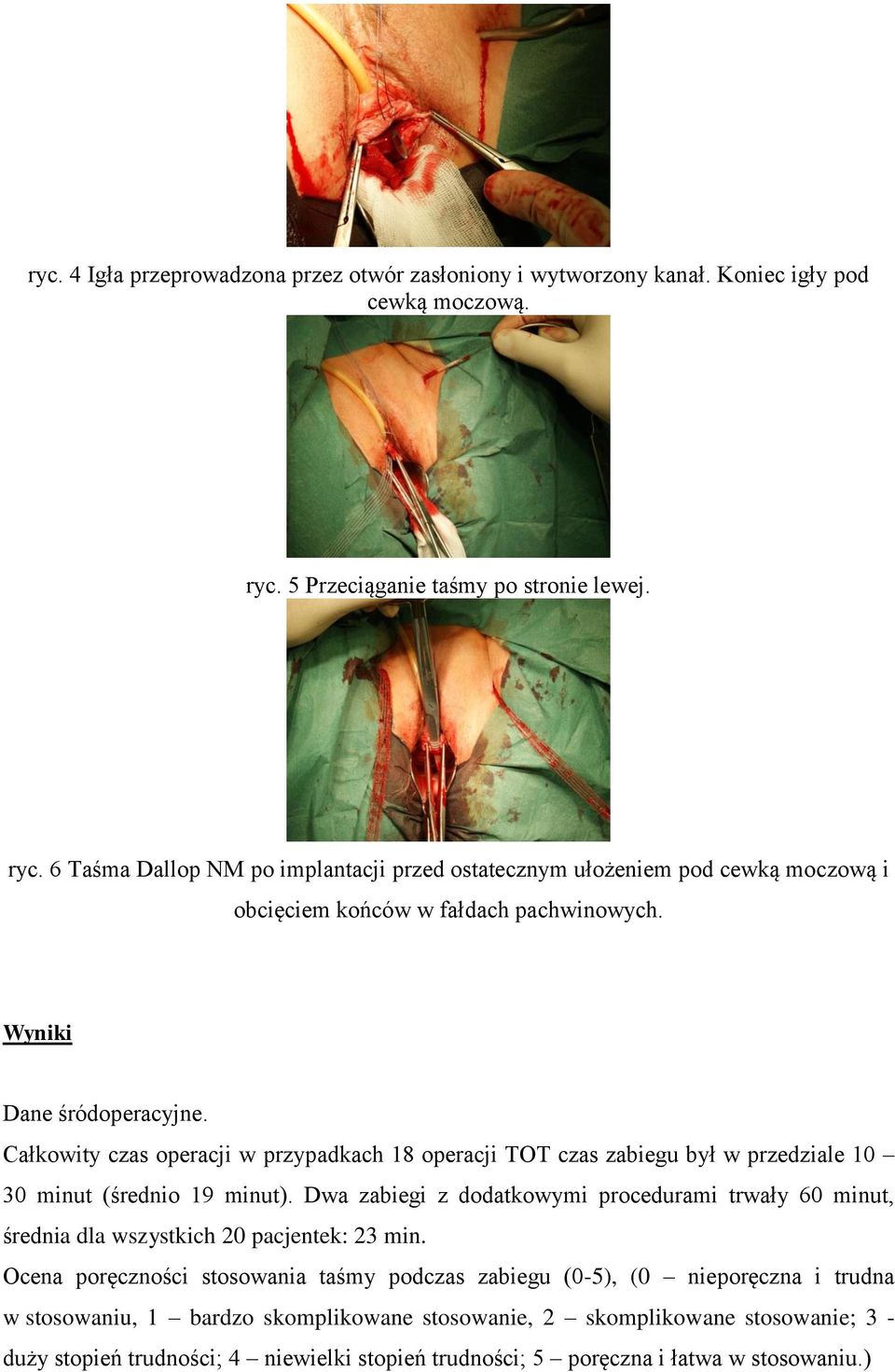 Wyniki Dane śródoperacyjne. Całkowity czas operacji w przypadkach 18 operacji TOT czas zabiegu był w przedziale 10 30 minut (średnio 19 minut).