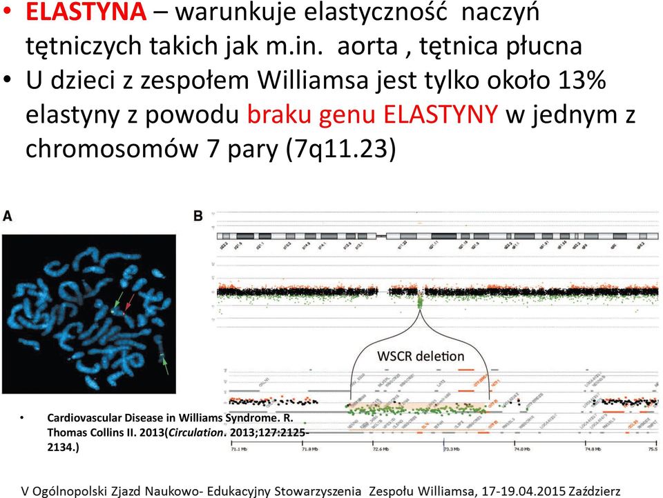 elastyny z powodu braku genu ELASTYNY w jednym z chromosomów 7 pary (7q11.