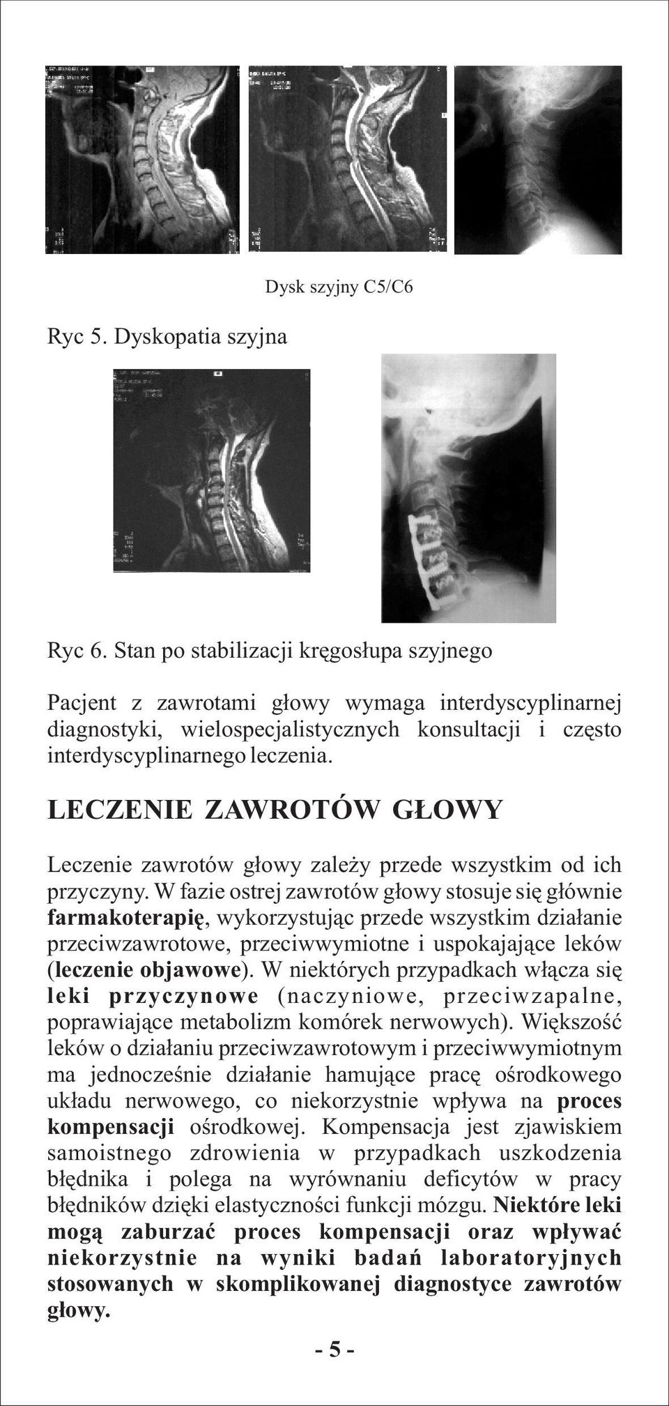 LECZENIE ZAWROTÓW G OWY Leczenie zawrotów g³owy zale y przede wszystkim od ich przyczyny.