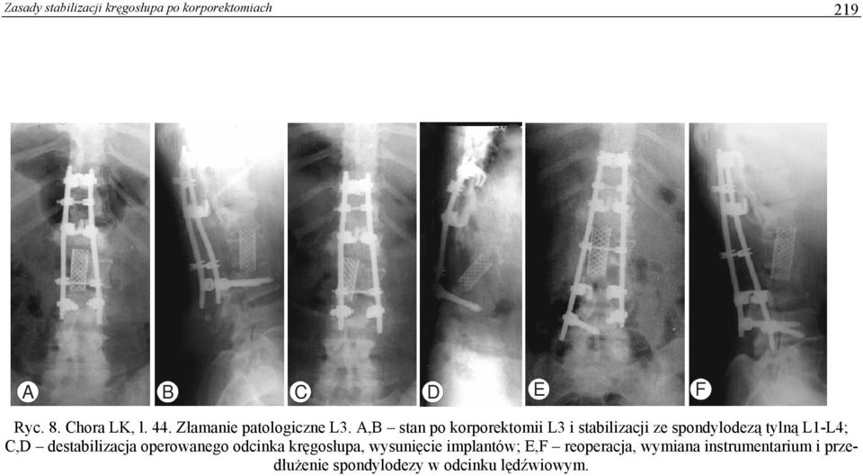 A,B stan po korporektomii L3 i stabilizacji ze spondylodezą tylną L1-L4; C,D