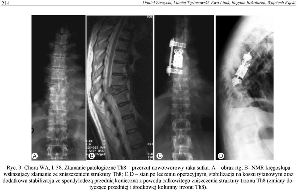 A obraz rtg; B- NMR kręgosłupa wskazujący złamanie ze zniszczeniem struktury Th8; C,D stan po leczeniu operacyjnym,
