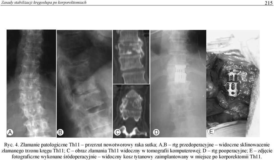 sklinowacenie złamanego trzonu kręgu Th11; C obraz złamania Th11 widoczny w tomografii komputerowej;