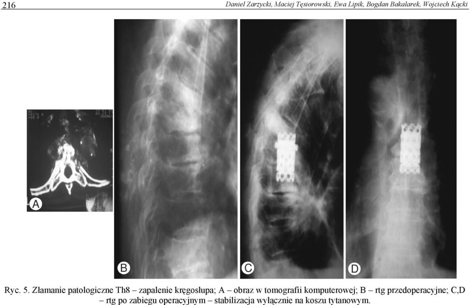 Złamanie patologiczne Th8 zapalenie kręgosłupa; A obraz w tomografii
