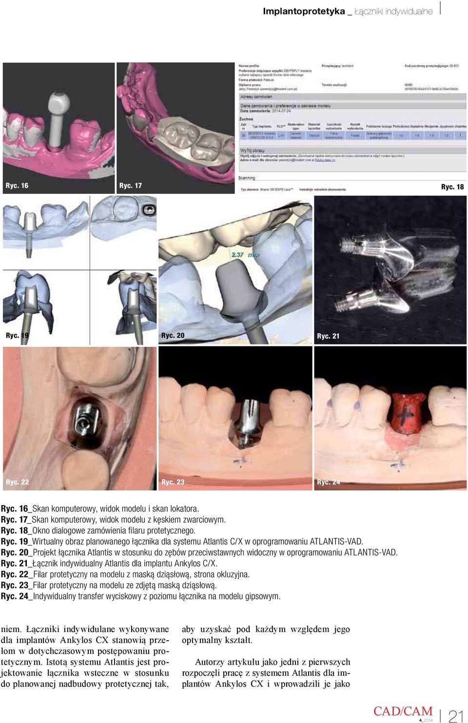 20_Projekt łącznika Atlantis w stosunku do zębów przeciwstawnych widoczny w oprogramowaniu ATLANTIS-VAD. Ryc. 21_Łącznik indywidualny Atlantis dla implantu Ankylos C/X. Ryc. 22_Filar protetyczny na modelu z maską dziąsłową, strona okluzyjna.