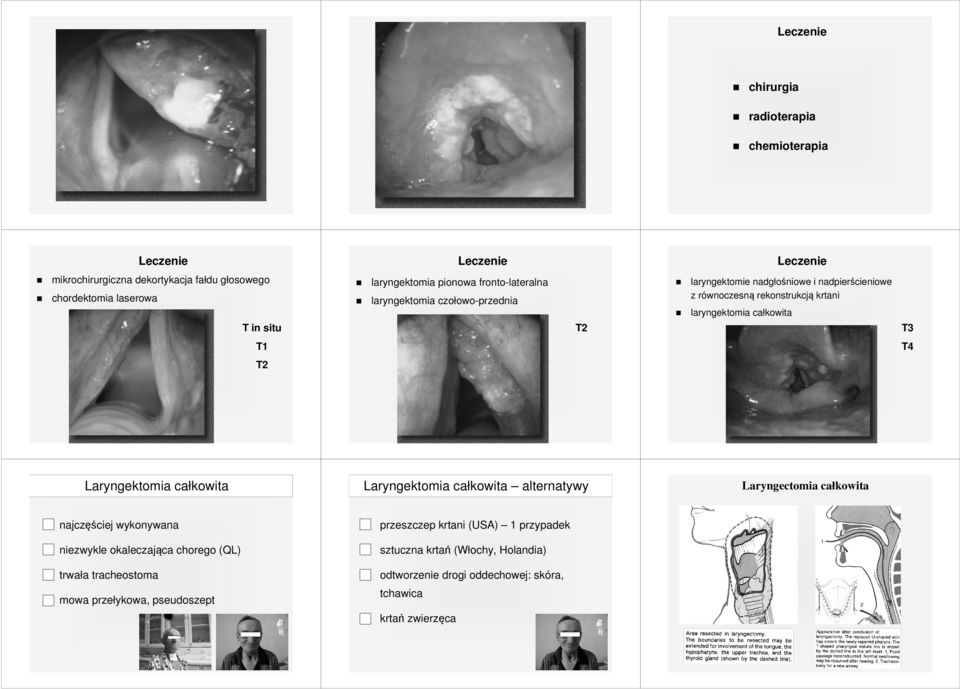 T2 Laryngektomia całkowita Laryngektomia całkowita alternatywy najczęściej wykonywana przeszczep krtani (USA) 1 przypadek niezwykle okaleczająca chorego (QL)