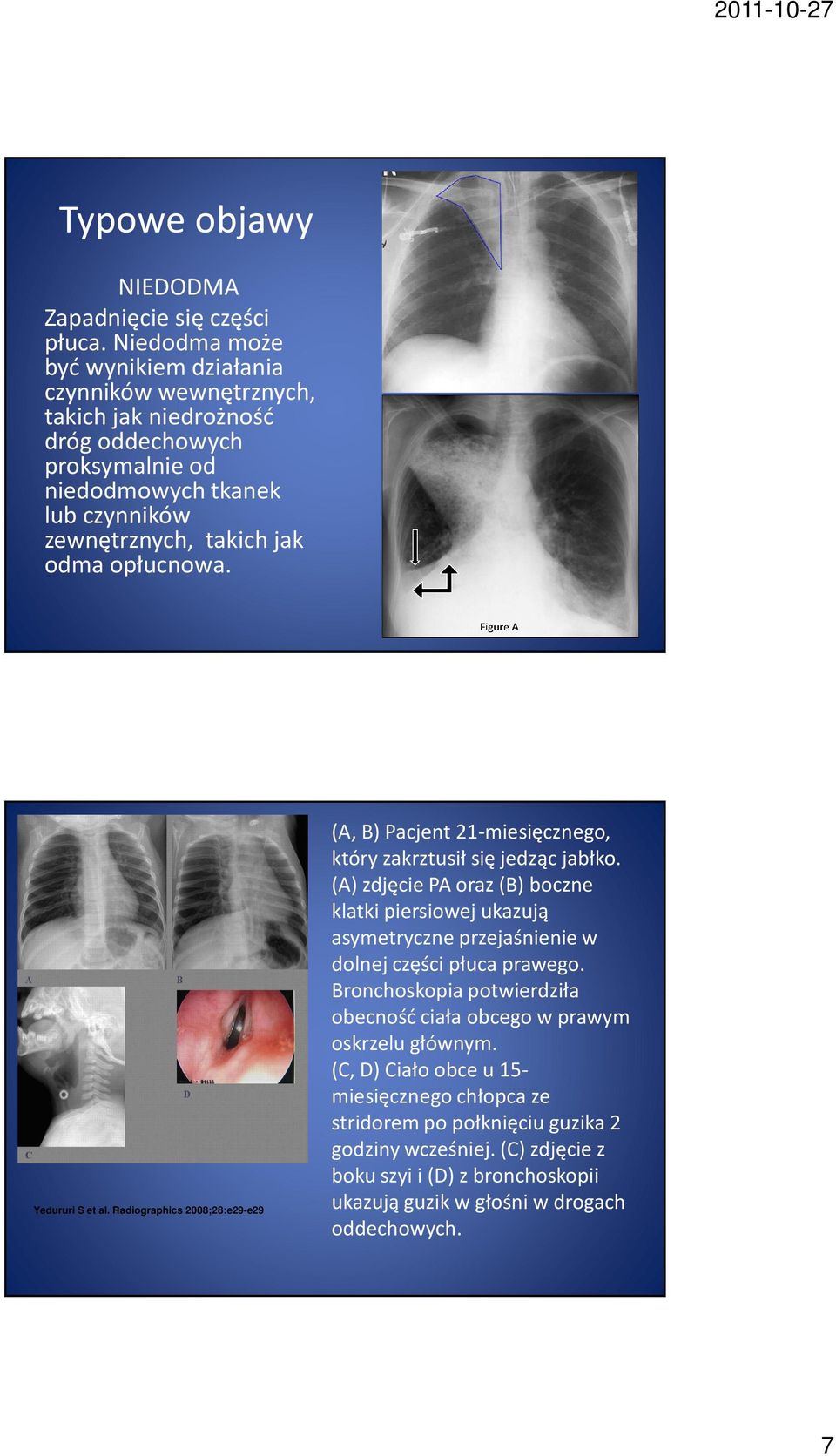 opłucnowa. Yedururi S et al. Radiographics 2008;28:e29-e29 (A, B) Pacjent 21-miesięcznego, który zakrztusił się jedząc jabłko.