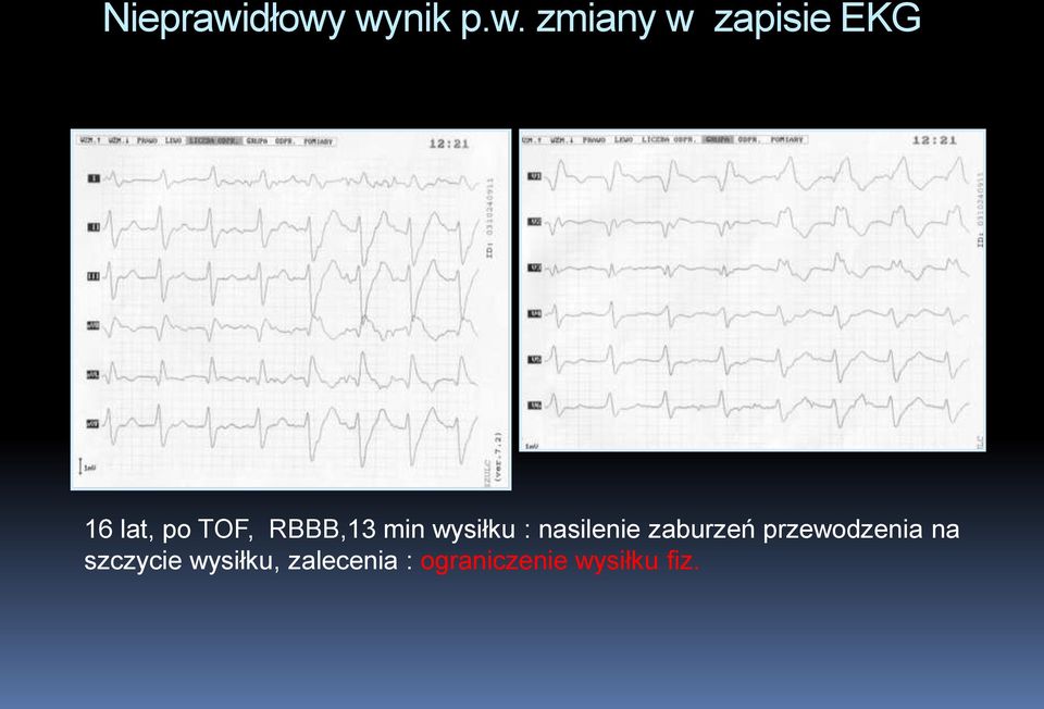 lat, po TOF, RBBB,13 min wysiłku :