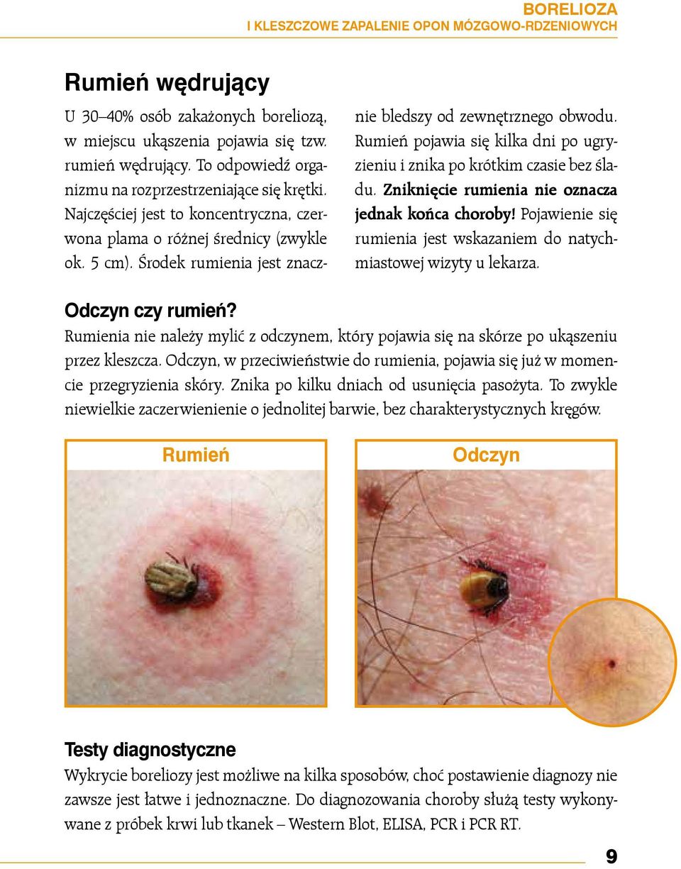 Środek rumienia jest znacznie bledszy od zewnętrznego obwodu. Rumień pojawia się kilka dni po ugryzieniu i znika po krótkim czasie bez śladu. Zniknięcie rumienia nie oznacza jednak końca choroby!