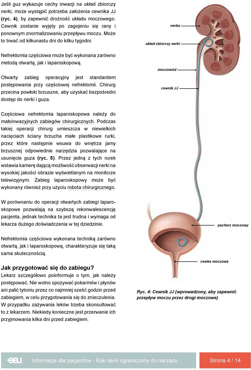 Nefrektomia częściowa może być wykonana zarówno metodą otwartą, jak i laparoskopową. Otwarty zabieg operacyjny jest standardem postępowania przy częściowej nefrektomii.