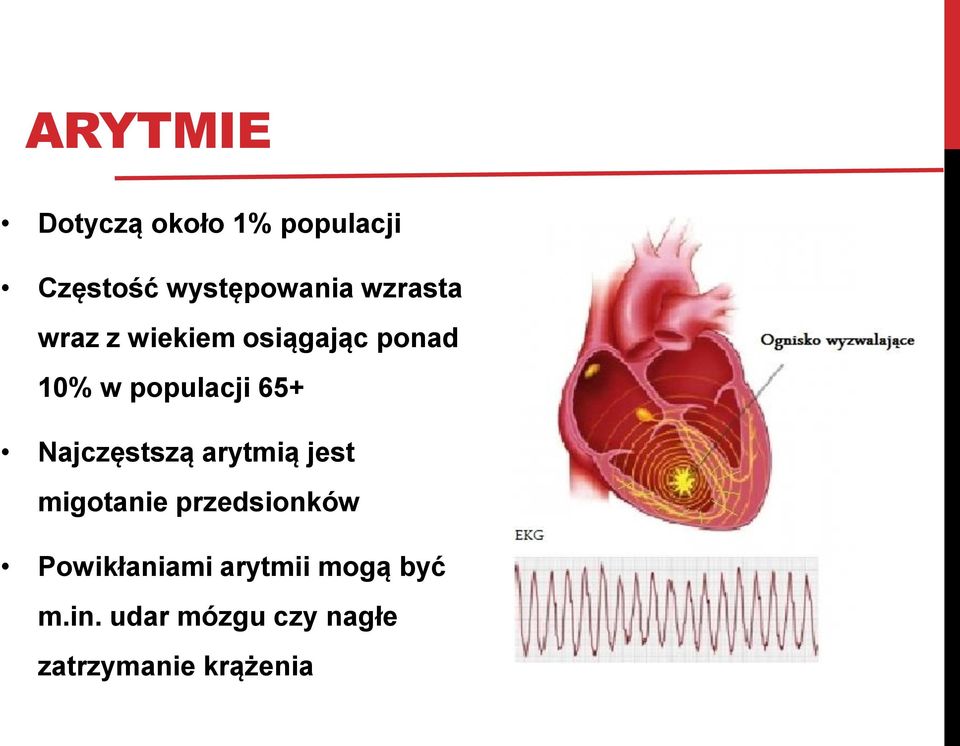 Najczęstszą arytmią jest migotanie przedsionków Powikłaniami