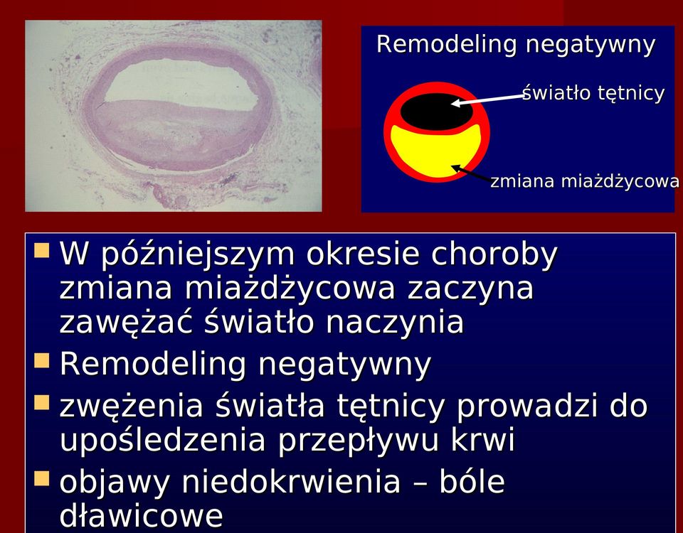 światło naczynia Remodeling negatywny zwężenia światła tętnicy