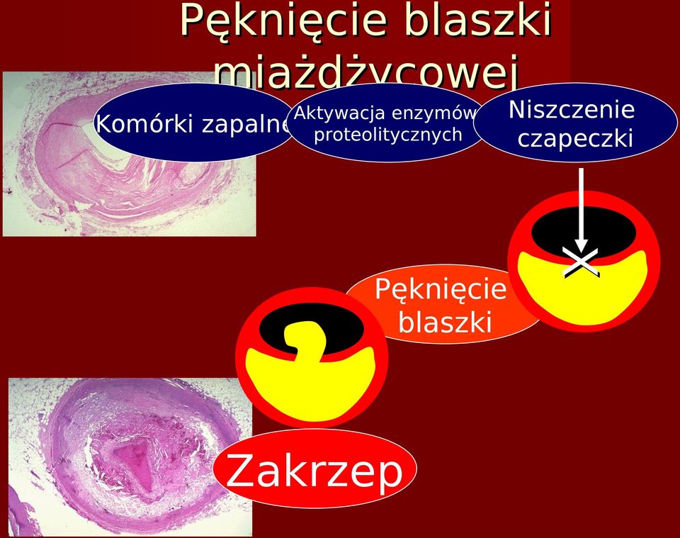 zapalne proteolitycznych Zakrzep