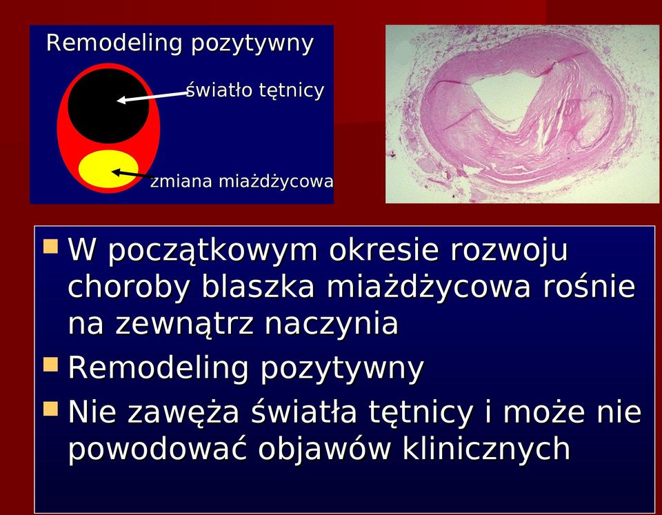 rośnie na zewnątrz naczynia Remodeling pozytywny Nie