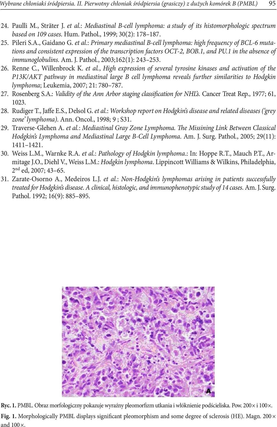 : Primary mediastinal B-cell lymphoma: high frequency of BCL-6 mutations and consistent expression of the transcription factors OCT-2, BOB.1, and PU.1 in the absence of immunoglobulins. Am. J. Pathol.