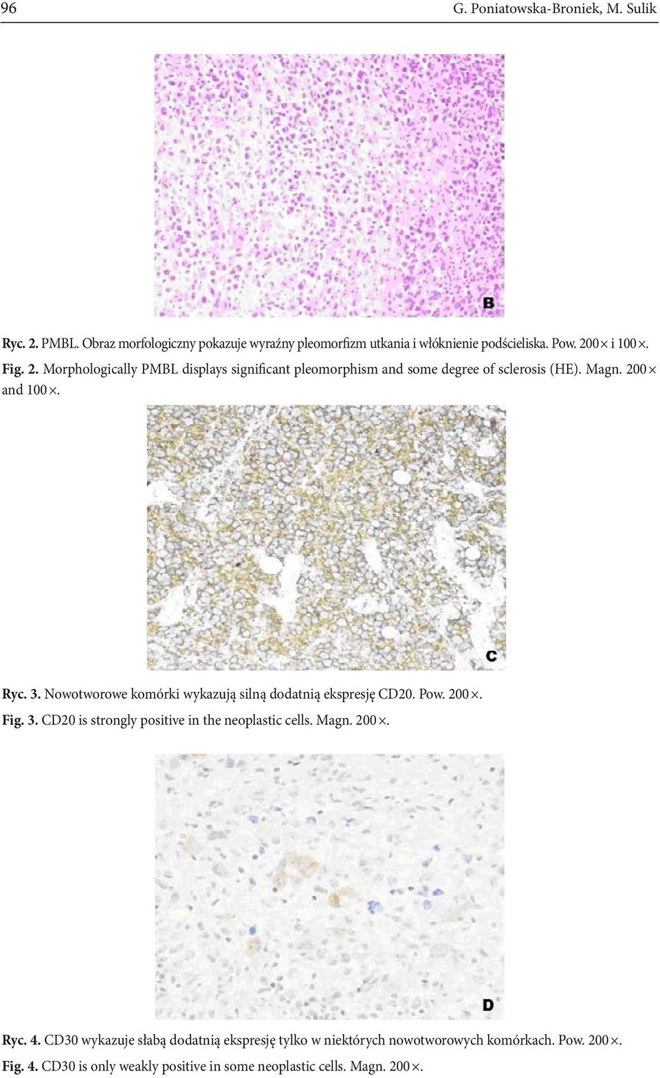 Magn. 200. Ryc. 4. CD30 wykazuje słabą dodatnią ekspresję tylko w niektórych nowotworowych komórkach. Pow. 200. Fig. 4. CD30 is only weakly positive in some neoplastic cells.