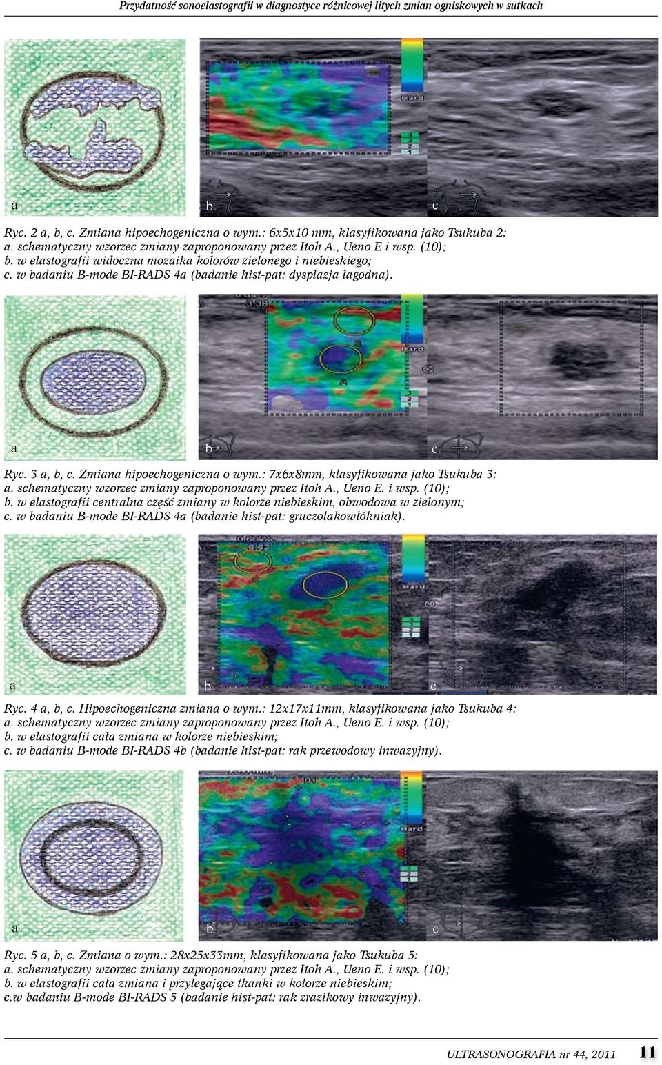 w badaniu B-mode BI-RADS 4a (badanie hist-pat: dysplazja łagodna). a b c Ryc. 3 a, b, c. Zmiana hipoechogeniczna o wym.: 7x6x8mm, klasyfikowana jako Tsukuba 3: a.