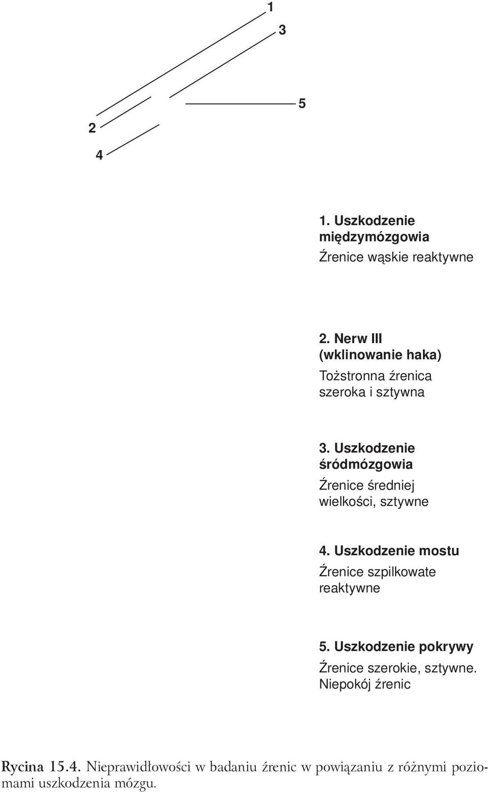 Nerw III (wklinowanie haka) Tożstronna źrenica szeroka i sztywna 3.