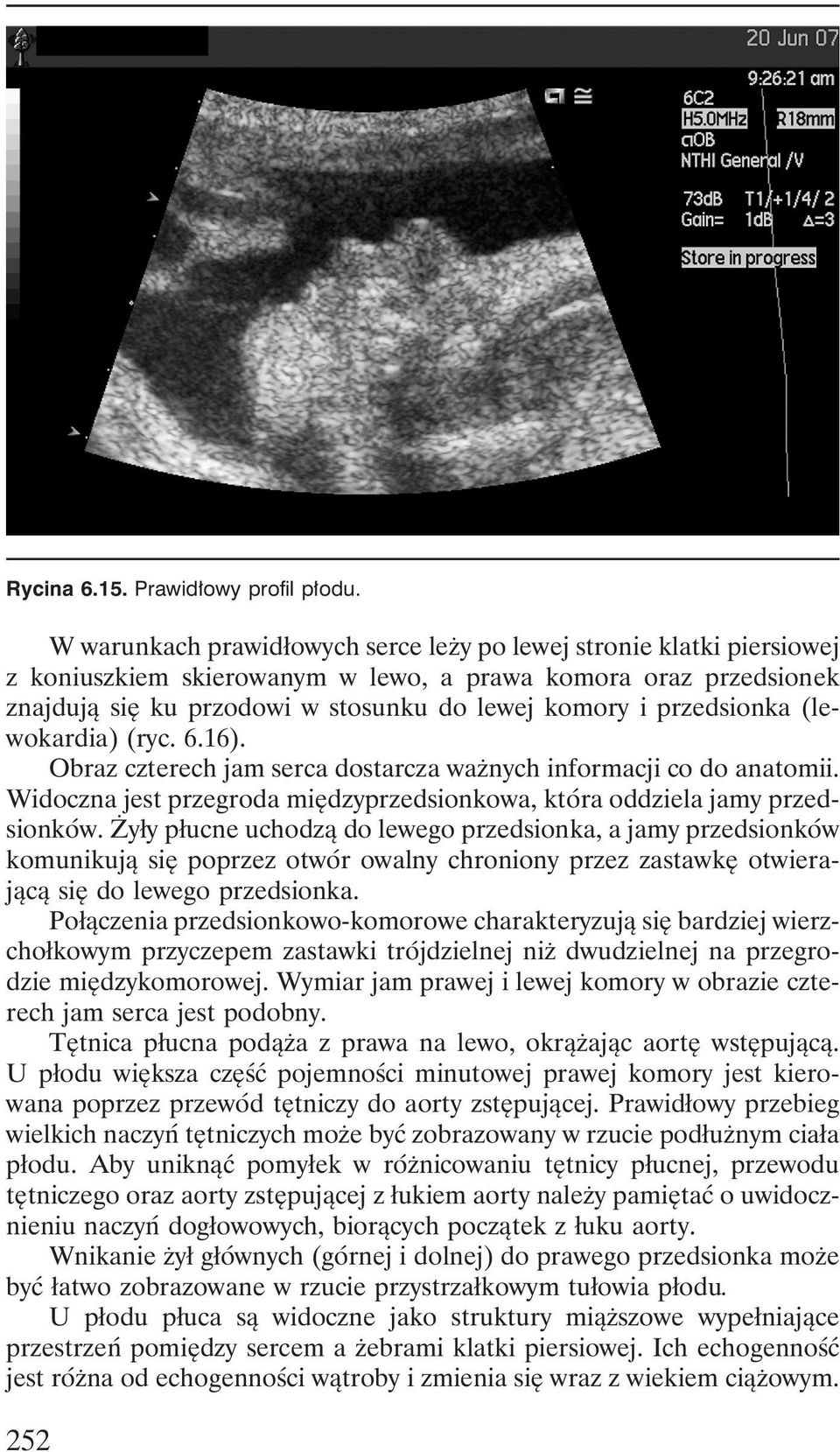 przedsionka (lewokardia) (ryc. 6.16). Obraz czterech jam serca dostarcza ważnych informacji co do anatomii. Widoczna jest przegroda międzyprzedsionkowa, która oddziela jamy przedsionków.