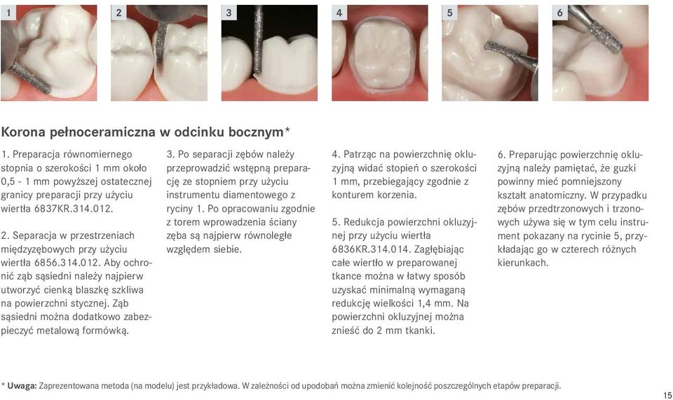 Ząb sąsiedni można dodatkowo zabezpieczyć metalową formówką. 3. Po separacji zębów należy przeprowadzić wstępną preparację ze stopniem przy użyciu instrumentu diamentowego z ryciny 1.