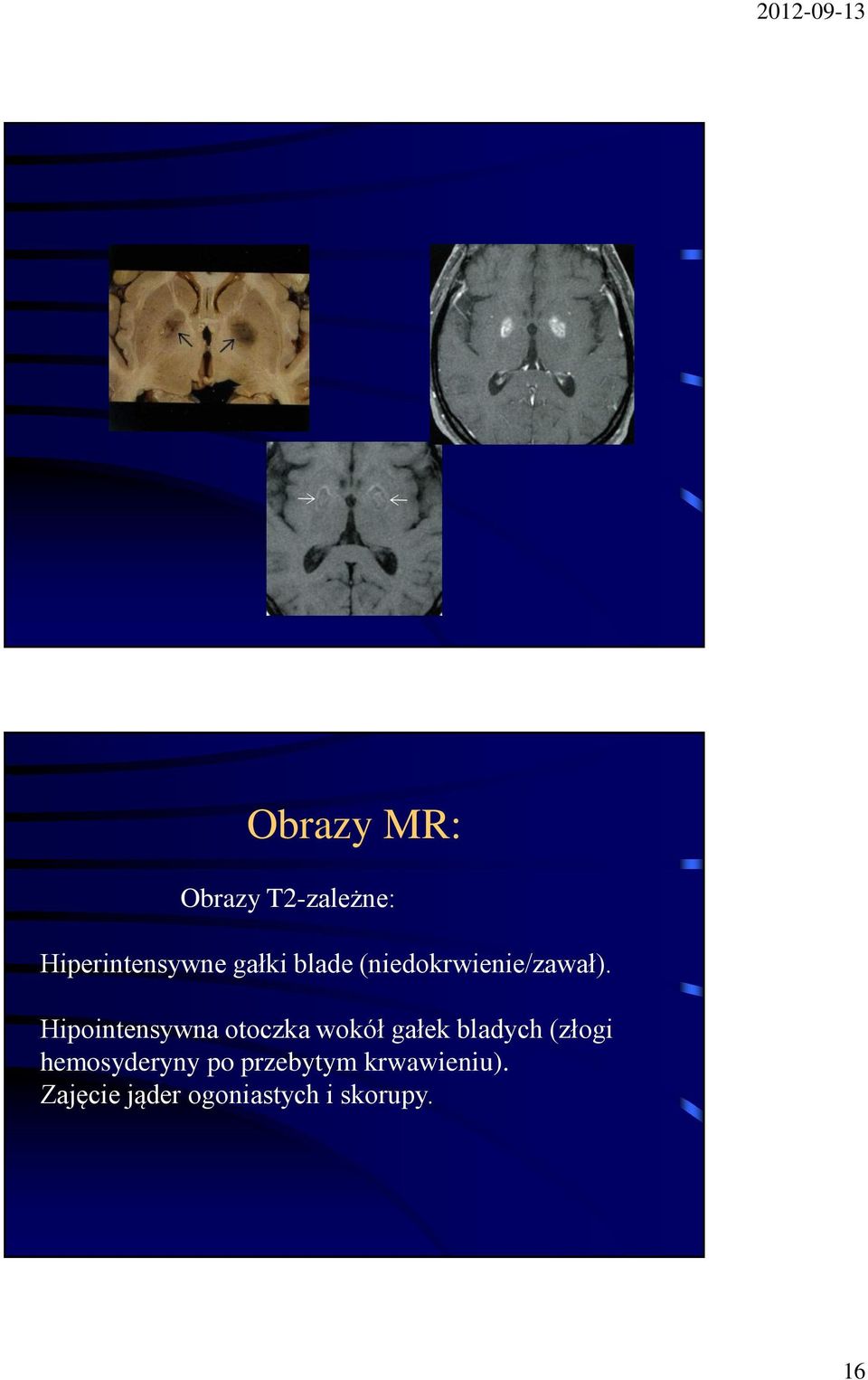 Hipointensywna otoczka wokół gałek bladych (złogi