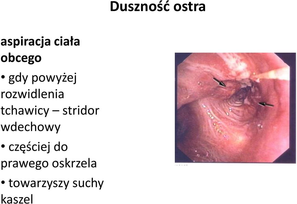 tchawicy stridor wdechowy częściej