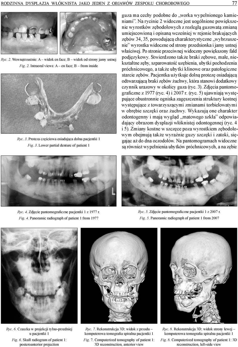 Na rycinie 2 widoczne jest uogólnione powiększenie wyrostków zębodołowych z rozległą guzowatą zmianą umiejscowioną i opisaną wcześniej w rejonie brakujących zębów 34, 35, powodującą charakterystyczne