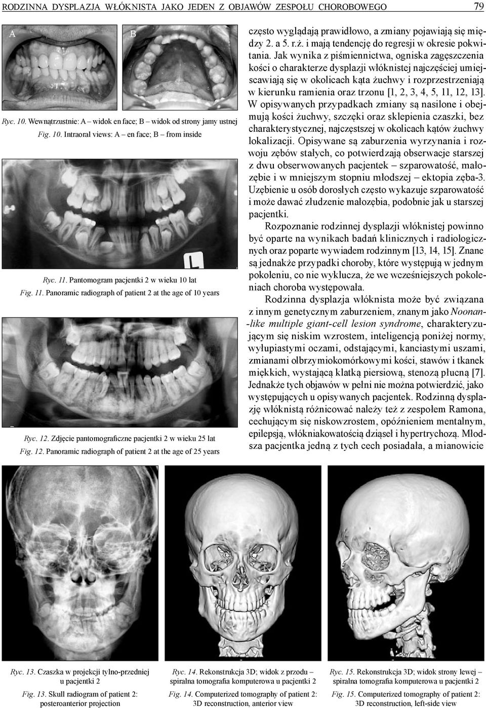 Zdjęcie pantomograficzne pacjentki 2 w wieku 25 lat Fig. 12. Panoramic radiograph of patient 2 at the age of 25 years często wyglądają prawidłowo, a zmiany pojawiają się między 2. a 5. r.ż.