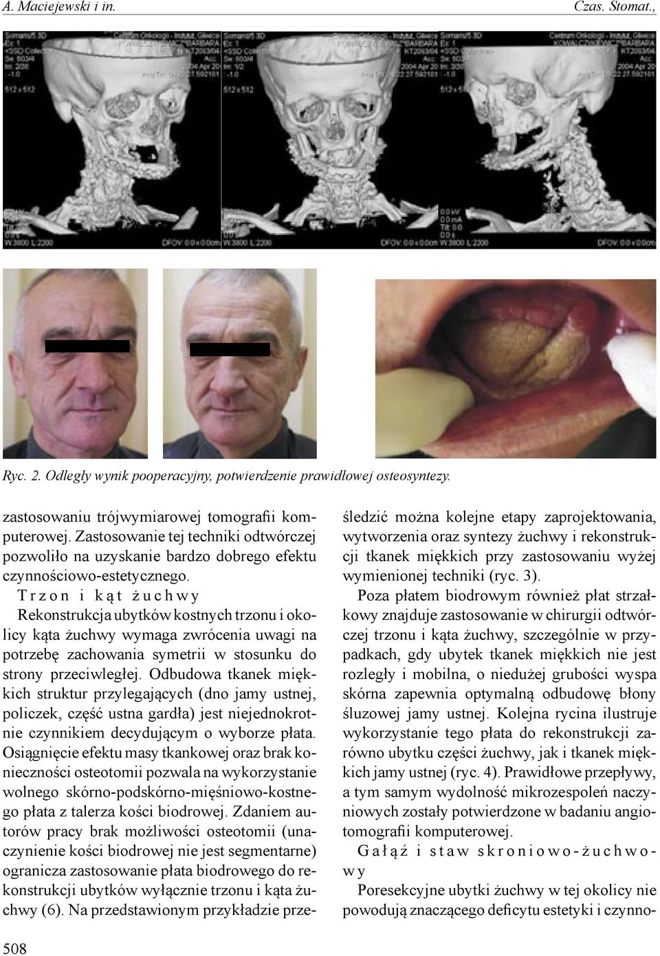 T r z o n i k ą t ż u c h w y Rekonstrukcja ubytków kostnych trzonu i okolicy kąta żuchwy wymaga zwrócenia uwagi na potrzebę zachowania symetrii w stosunku do strony przeciwległej.