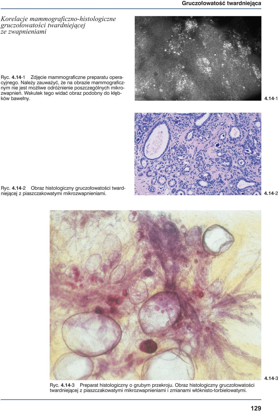 Wskutek tego widać obraz podobny do kłębków bawełny. 4.14-1 Ryc. 4.14-2 Obraz histologiczny gruczołowatości twardniejącej z piaszczakowatymi mikrozwapnieniami.