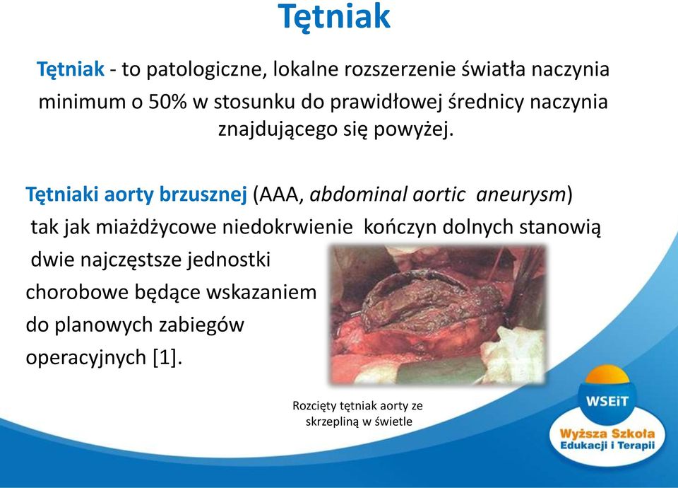 Tętniaki aorty brzusznej (AAA, abdominal aortic aneurysm) tak jak miażdżycowe niedokrwienie kończyn