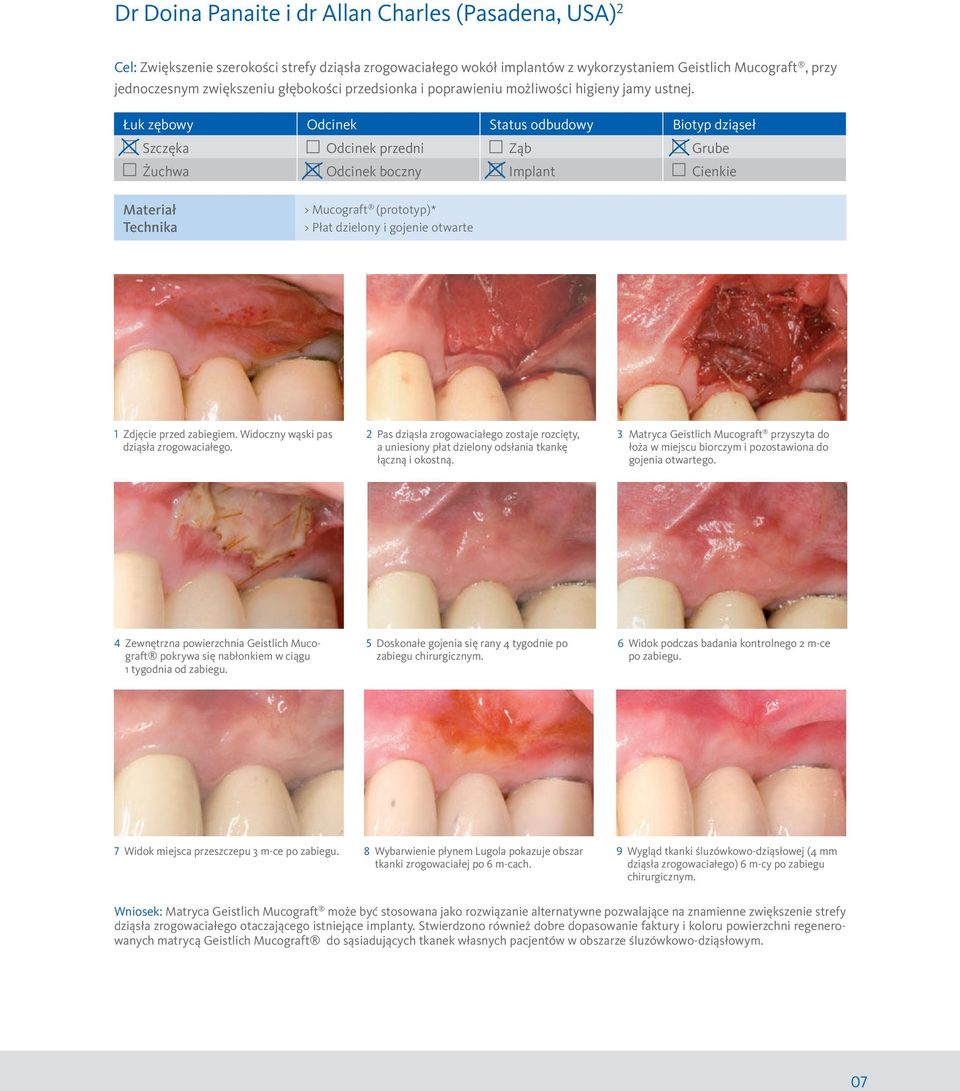 Łuk zębowy Odcinek Status odbudowy Biotyp dziąseł Szczęka Odcinek przedni Ząb Grube Żuchwa Odcinek boczny Implant Cienkie Materiał Technika > Mucograft (prototyp)* > Płat dzielony i gojenie otwarte 1