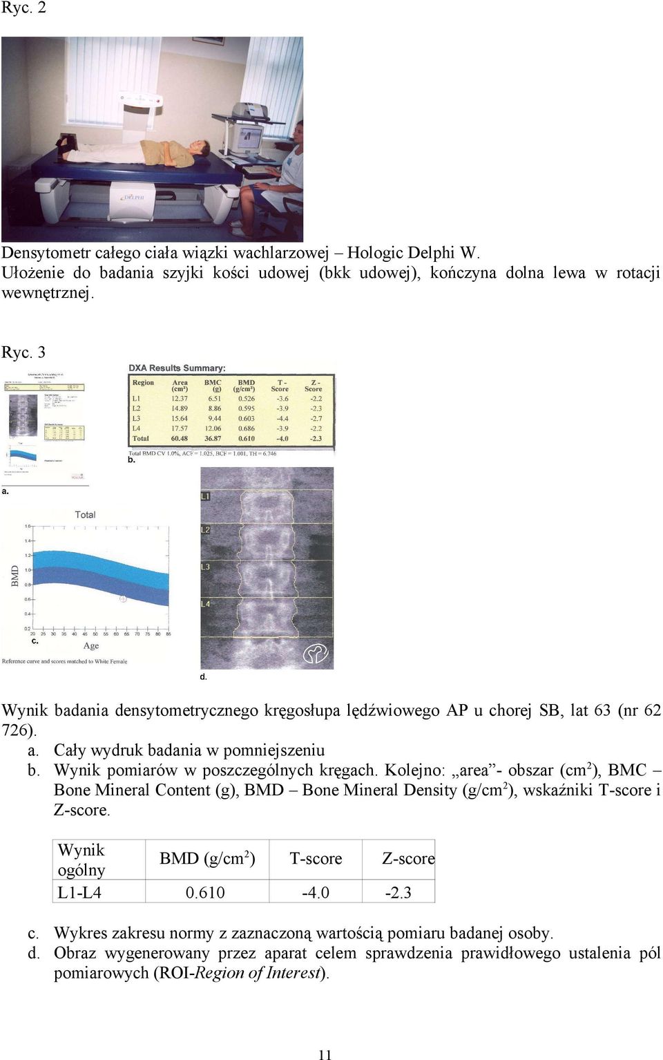 Kolejno: area - obszar (cm 2 ), BMC Bone Mineral Content (g), BMD Bone Mineral Density (g/cm 2 ), wskaźniki T-score i Z-score. Wynik ogólny BMD (g/cm 2 ) T-score Z-score L1-L4 0.