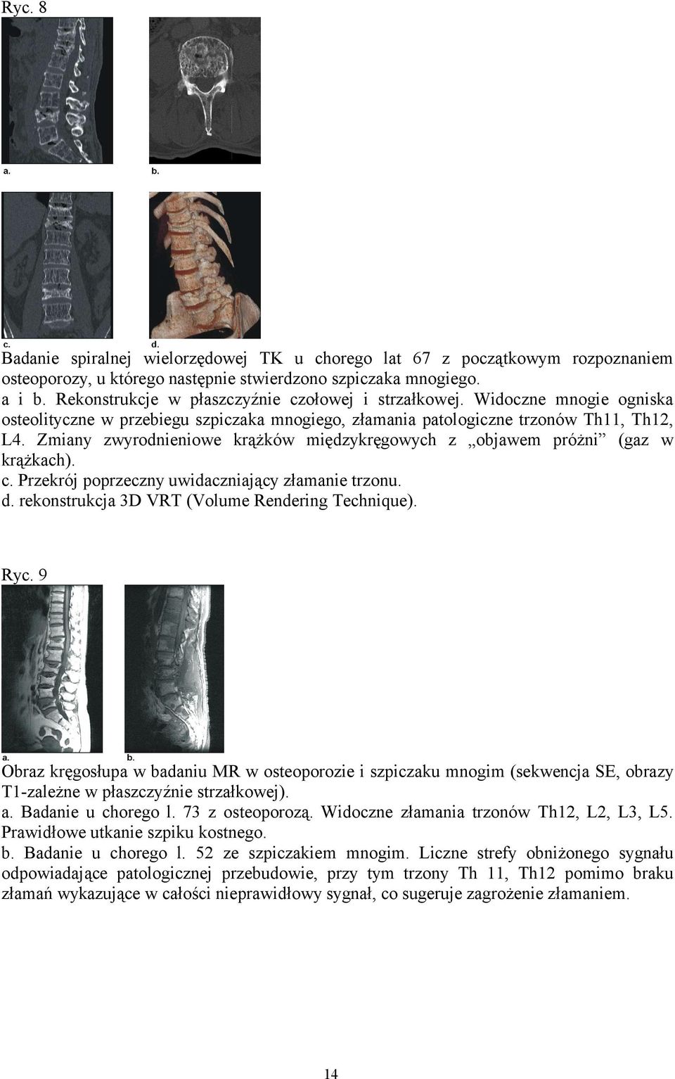 Zmiany zwyrodnieniowe krążków międzykręgowych z objawem próżni (gaz w krążkach). c. Przekrój poprzeczny uwidaczniający złamanie trzonu. d. rekonstrukcja 3D VRT (Volume Rendering Technique). Ryc.