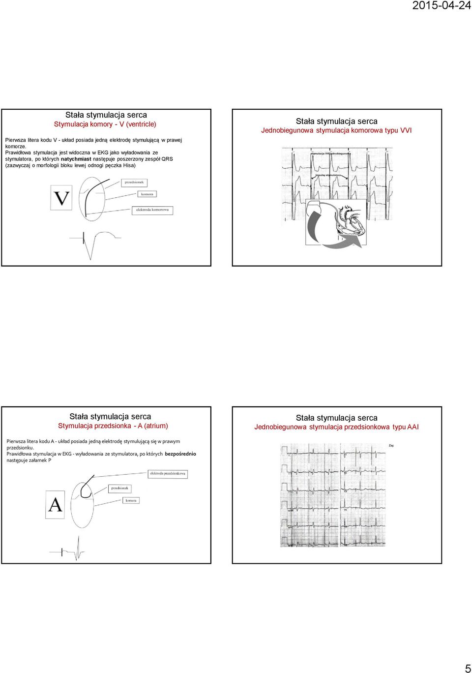 bloku lewej odnogi pęczka Hisa) Jednobiegunowa stymulacja komorowa typu VVI Stymulacja przedsionka - A (atrium) Jednobiegunowa stymulacja przedsionkowa typu