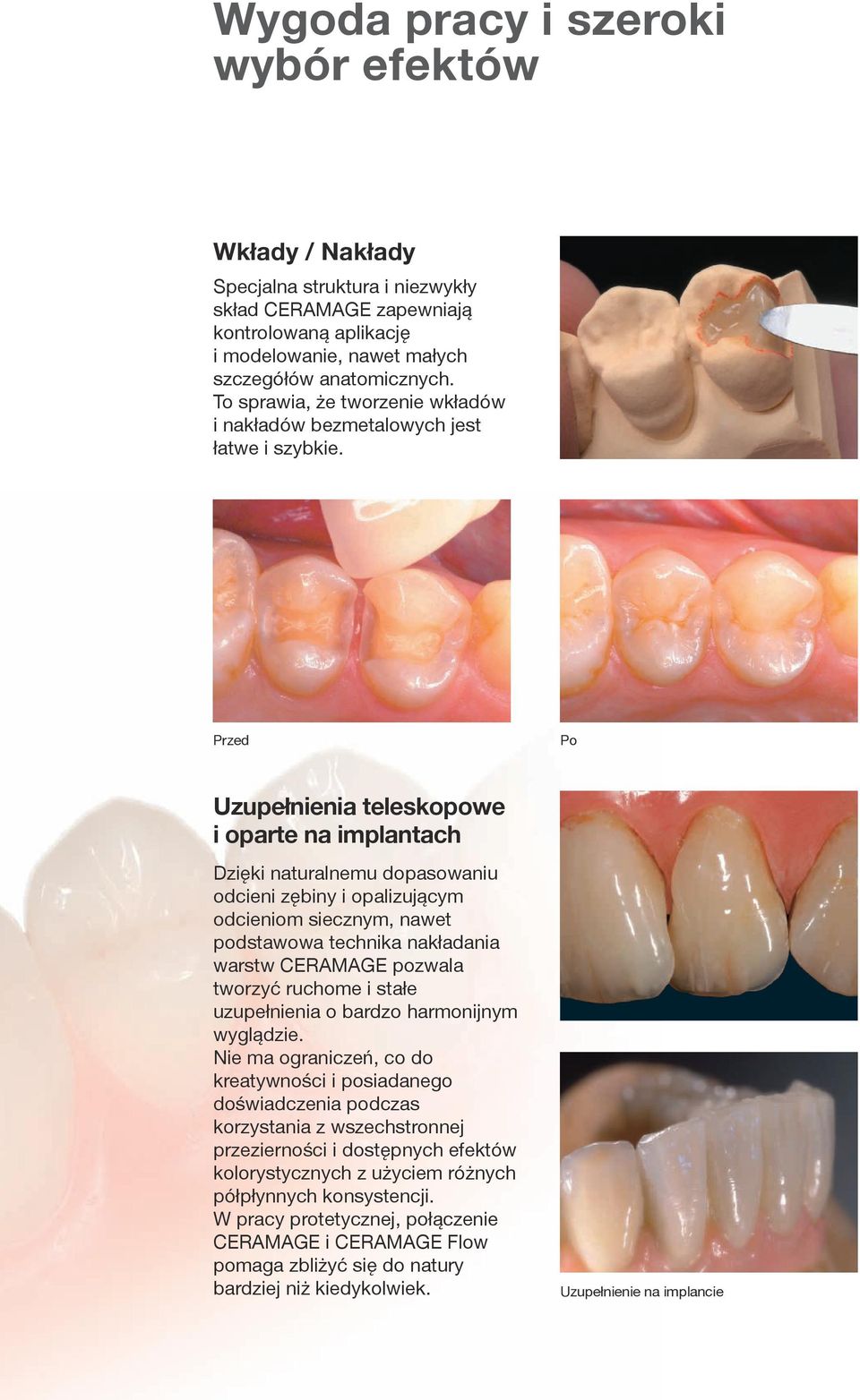 Przed Po Uzupełnienia teleskopowe i oparte na implantach Dzięki naturalnemu dopasowaniu odcieni zębiny i opalizującym odcieniom siecznym, nawet podstawowa technika nakładania warstw CERAMAGE pozwala