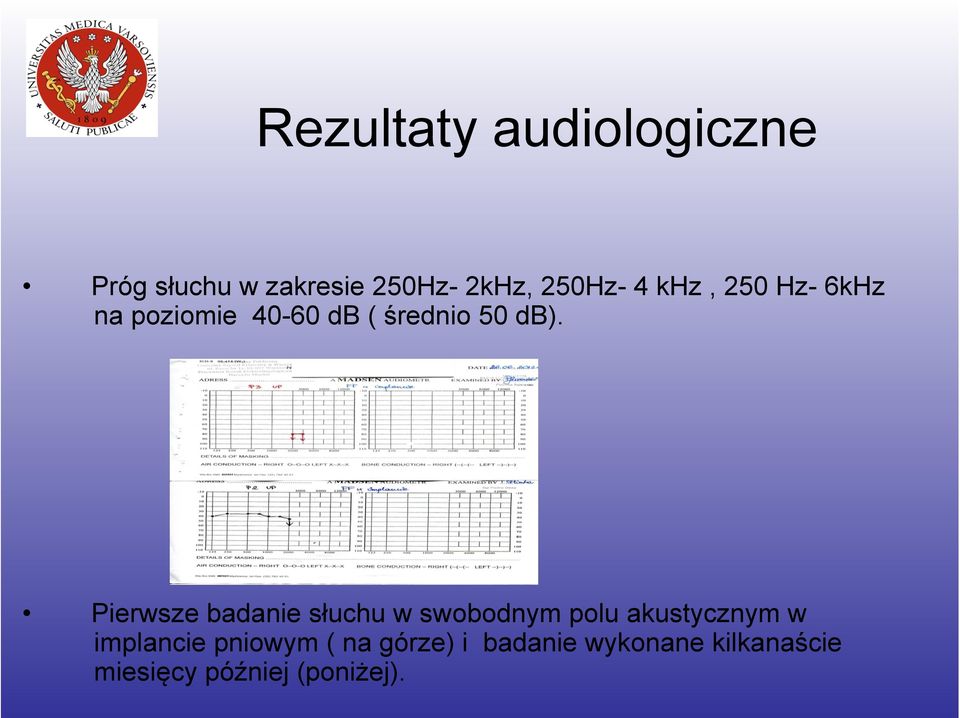 Pierwsze badanie słuchu w swobodnym polu akustycznym w implancie