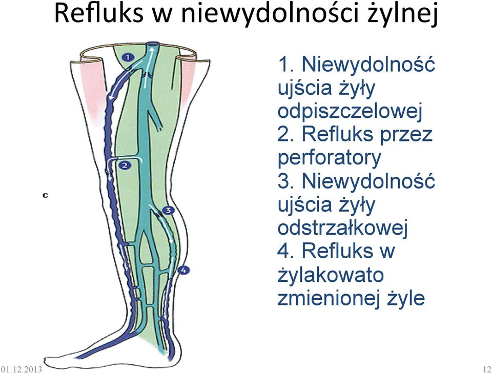 Refluks przez perforatory 3.