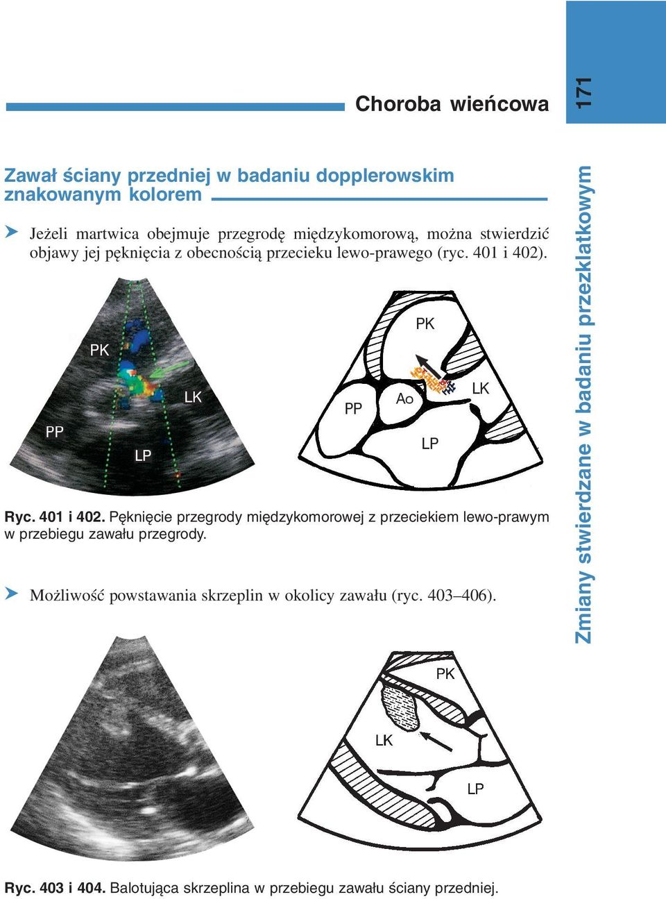 Ryc. 401 i 402. Pęknięcie przegrody międzykomorowej z przeciekiem lewo-prawym w przebiegu zawału przegrody.