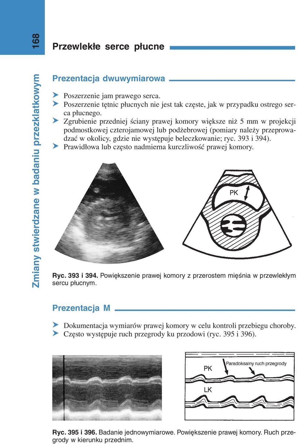 393 i 394). S Prawidłowa lub często nadmierna kurczliwość prawej komory. Ryc. 393 i 394. Powiększenie prawej komory z przerostem mięśnia w przewlekłym sercu płucnym.