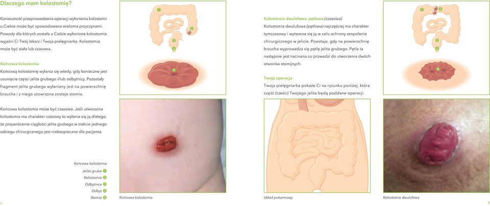 3 4 2 Kolostomia dwulufowa (pętlowa) najczęściej ma charakter tymczasowy i wytwarza się ją w celu ochrony zespolenia chirurgicznego w jelicie.