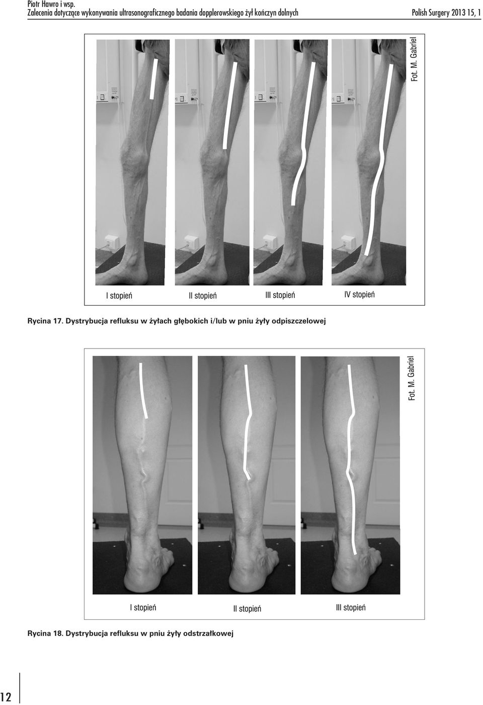 dopplerowskiego żył kończyn dolnych Polish Surgery 2013 15, 1 Rycina 17.