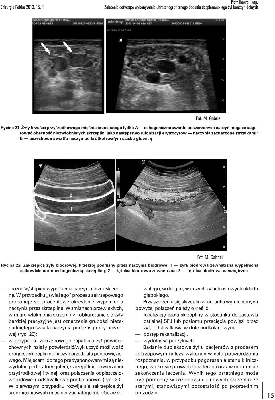 zaznaczone strzałkami; B bezechowe światło naczyń po krótkotrwałym ucisku głowicą Rycina 22. Zakrzepica żyły biodrowej.