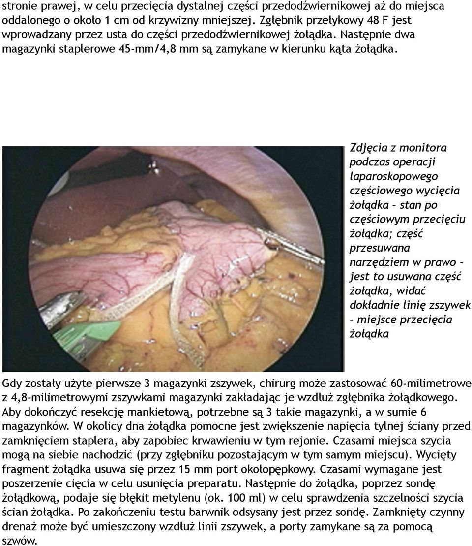 Zdjęcia z monitora podczas operacji laparoskopowego częściowego wycięcia żołądka stan po częściowym przecięciu żołądka; część przesuwana narzędziem w prawo - jest to usuwana część żołądka, widać