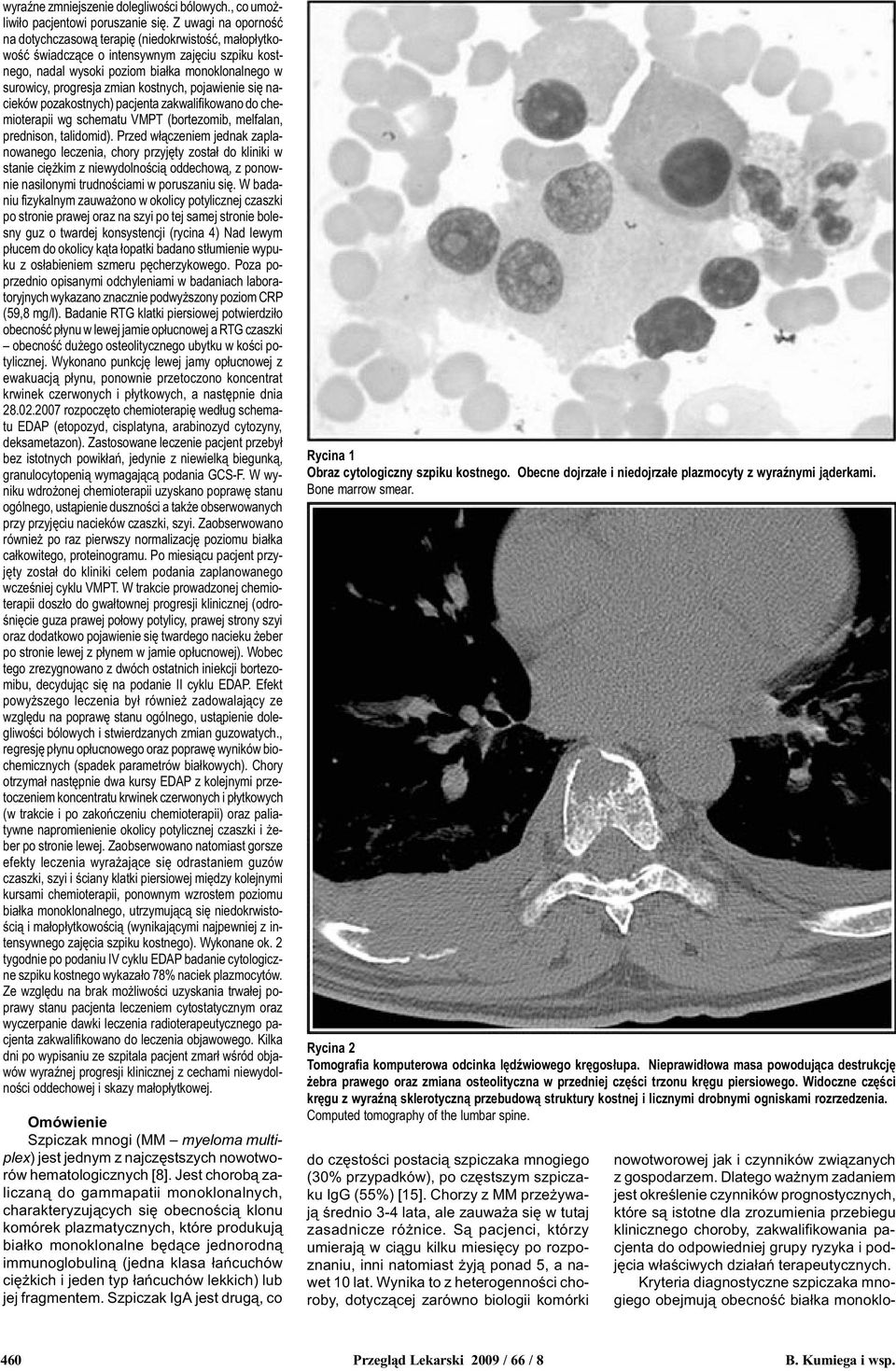kostnych, pojawienie siê nacieków pozakostnych) pacjenta zakwalifikowano do chemioterapii wg schematu VMPT (bortezomib, melfalan, prednison, talidomid).