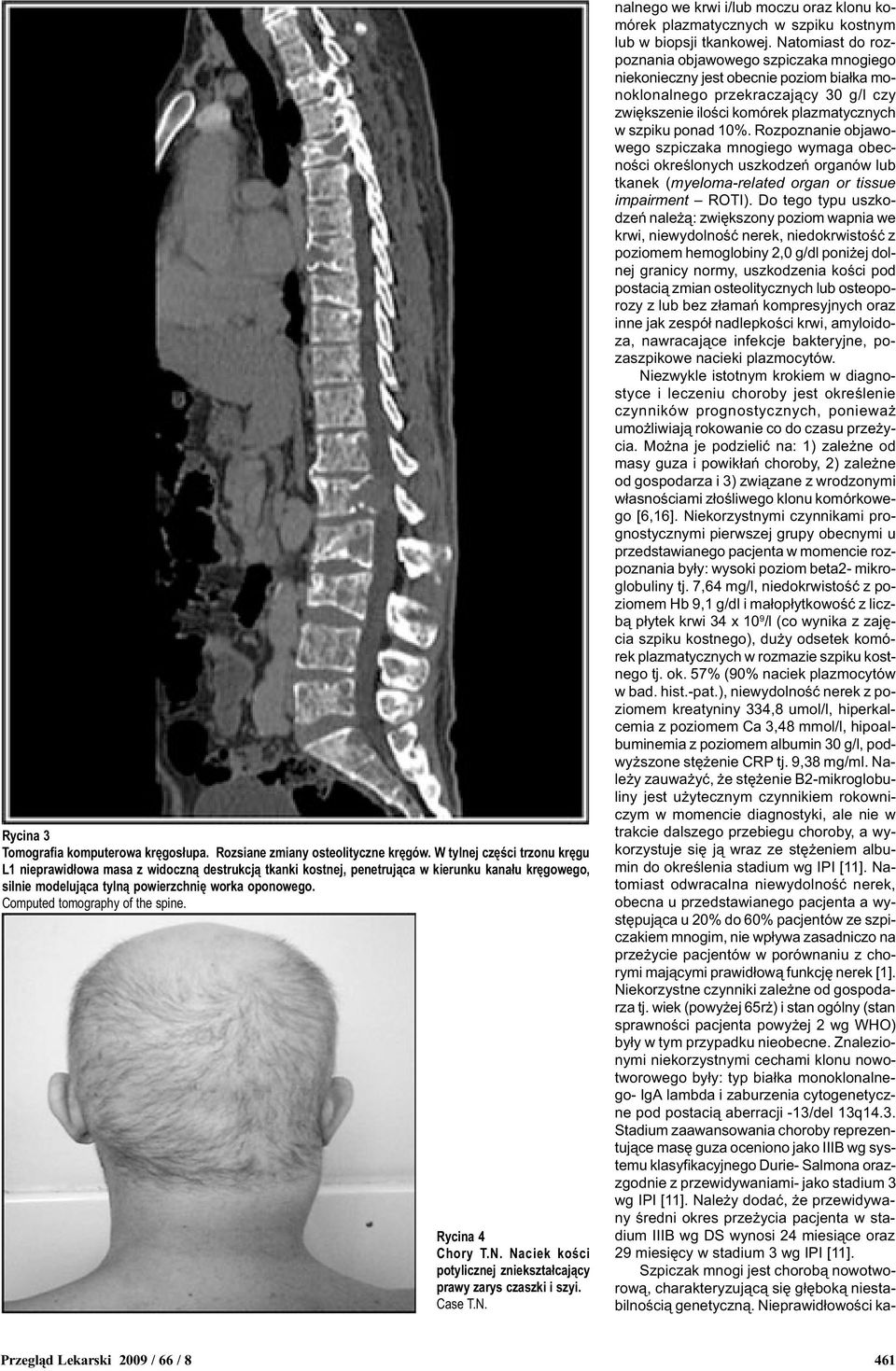 Computed tomography of the spine. Rycina 4 Chory T.N. Naciek koœci potylicznej zniekszta³caj¹cy prawy zarys czaszki i szyi. Case T.N. nalnego we krwi i/lub moczu oraz klonu komórek plazmatycznych w szpiku kostnym lub w biopsji tkankowej.