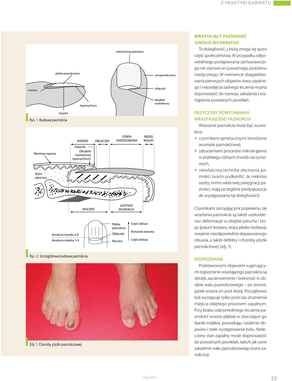 obrąbek naskórkowy WRASTAJĄCY PAZNOKIEĆ (UNGUIS INCARNATUS) To dolegliwość, z którą zmaga się spora część społeczeństwa.