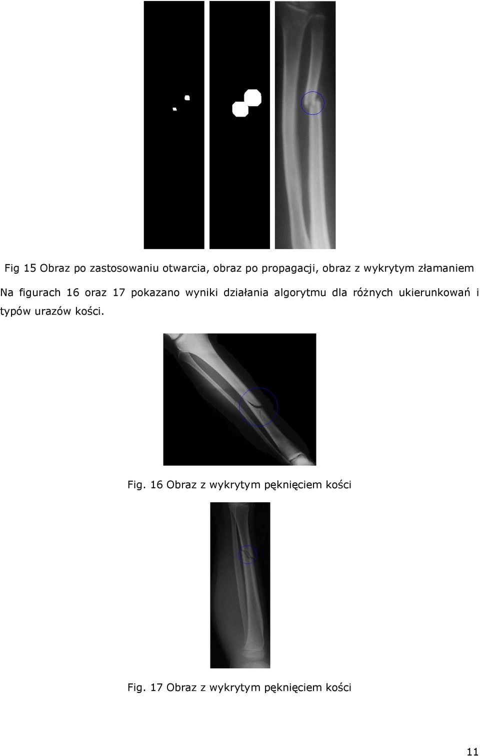 algorytmu dla różnych ukierunkowań i typów urazów kości. Fig.