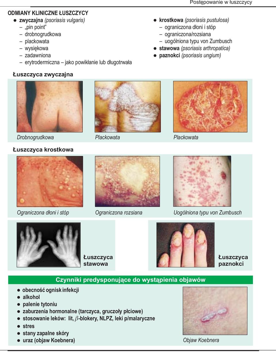 Łuszczyca krostkowa Ograniczona dłoni i stóp Ograniczona rozsiana Uogólniona typu von Zumbusch Łuszczyca stawowa Łuszczyca paznokci Czynniki predysponujące do wystąpienia objawów obecność ognisk