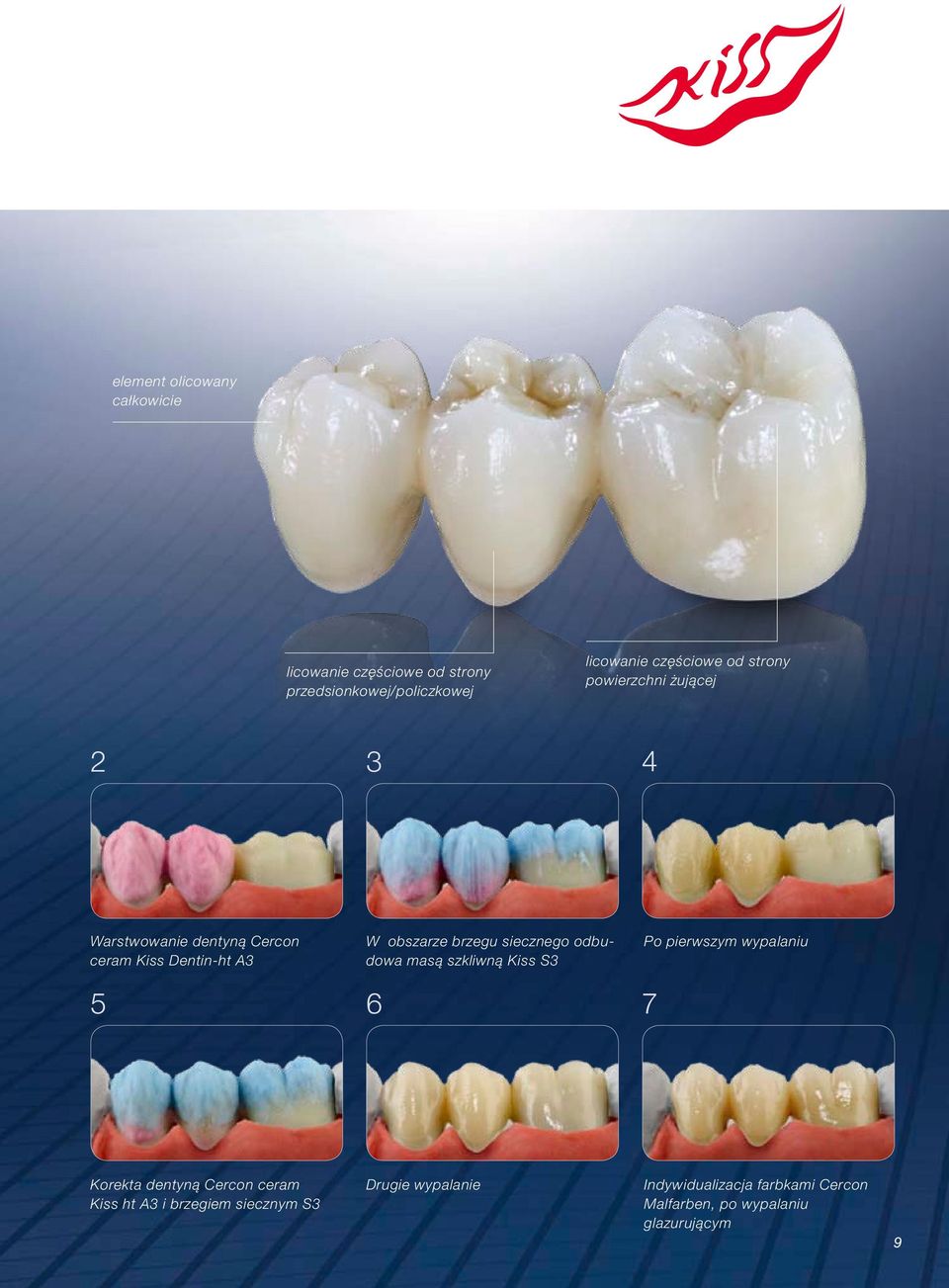 siecznego odbudowa masą szkliwną Kiss S3 Po pierwszym wypalaniu 5 6 7 Korekta dentyną Cercon ceram Kiss ht